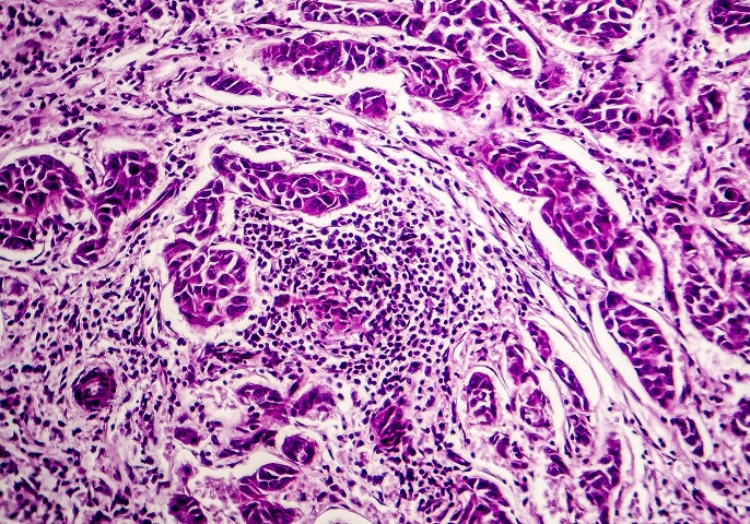 Gewebe mit Tumorzellen
